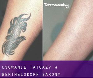 Usuwanie tatuaży w Berthelsdorf (Saxony)