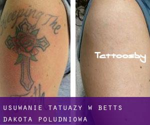 Usuwanie tatuaży w Betts (Dakota Południowa)