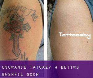 Usuwanie tatuaży w Bettws Gwerfil Goch
