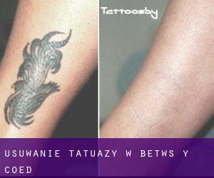 Usuwanie tatuaży w Betws-y-Coed