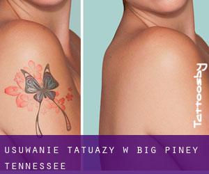 Usuwanie tatuaży w Big Piney (Tennessee)