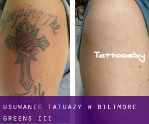 Usuwanie tatuaży w Biltmore Greens III