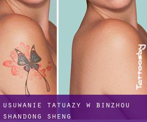 Usuwanie tatuaży w Binzhou (Shandong Sheng)