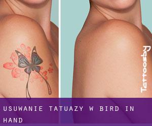 Usuwanie tatuaży w Bird in Hand