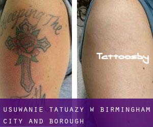 Usuwanie tatuaży w Birmingham (City and Borough)