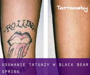Usuwanie tatuaży w Black Bear Spring