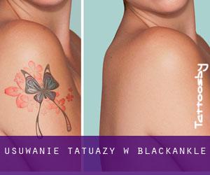 Usuwanie tatuaży w Blackankle