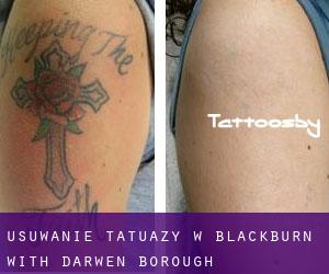 Usuwanie tatuaży w Blackburn with Darwen (Borough)