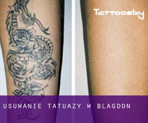 Usuwanie tatuaży w Blagdon