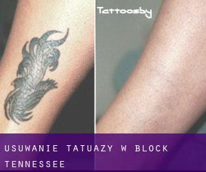 Usuwanie tatuaży w Block (Tennessee)