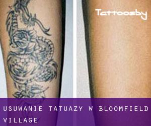 Usuwanie tatuaży w Bloomfield Village