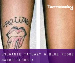 Usuwanie tatuaży w Blue Ridge Manor (Georgia)