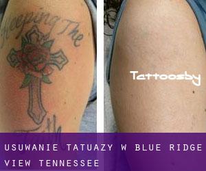 Usuwanie tatuaży w Blue Ridge View (Tennessee)