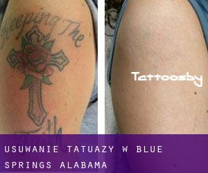 Usuwanie tatuaży w Blue Springs (Alabama)