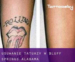 Usuwanie tatuaży w Bluff Springs (Alabama)