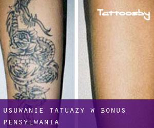 Usuwanie tatuaży w Bonus (Pensylwania)