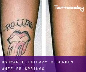 Usuwanie tatuaży w Borden Wheeler Springs