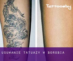 Usuwanie tatuaży w Borobia