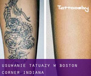 Usuwanie tatuaży w Boston Corner (Indiana)