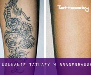 Usuwanie tatuaży w Bradenbaugh
