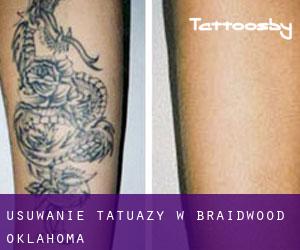 Usuwanie tatuaży w Braidwood (Oklahoma)