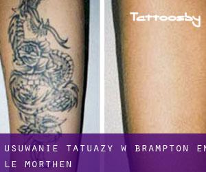 Usuwanie tatuaży w Brampton en le Morthen