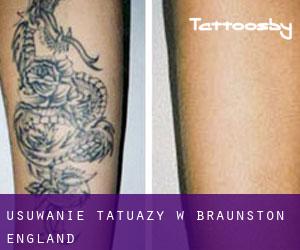 Usuwanie tatuaży w Braunston (England)