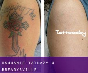 Usuwanie tatuaży w Breadysville