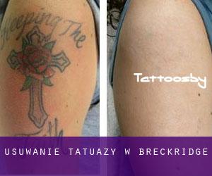 Usuwanie tatuaży w Breckridge