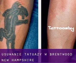 Usuwanie tatuaży w Brentwood (New Hampshire)