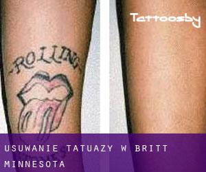 Usuwanie tatuaży w Britt (Minnesota)