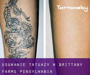 Usuwanie tatuaży w Brittany Farms (Pensylwania)