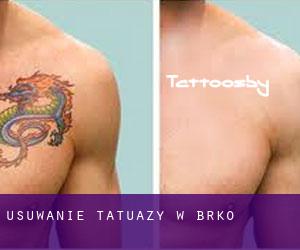 Usuwanie tatuaży w Brčko