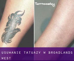 Usuwanie tatuaży w Broadlands West