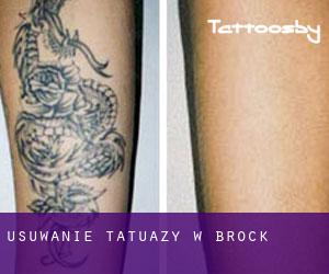 Usuwanie tatuaży w Brock