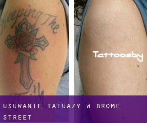 Usuwanie tatuaży w Brome Street