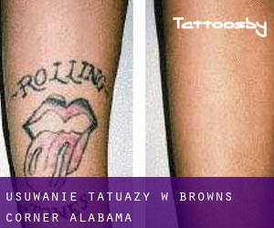 Usuwanie tatuaży w Browns Corner (Alabama)