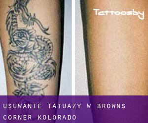 Usuwanie tatuaży w Browns Corner (Kolorado)