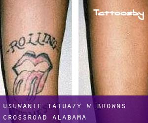 Usuwanie tatuaży w Browns Crossroad (Alabama)