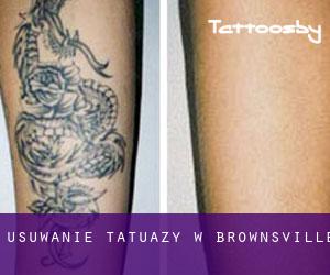 Usuwanie tatuaży w Brownsville