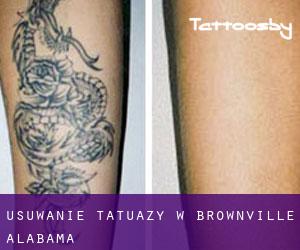 Usuwanie tatuaży w Brownville (Alabama)