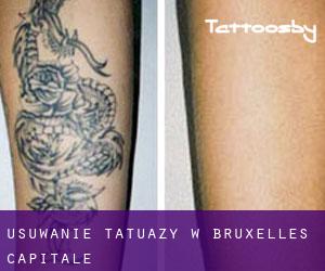 Usuwanie tatuaży w Bruxelles-Capitale