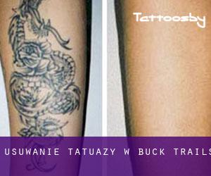 Usuwanie tatuaży w Buck Trails