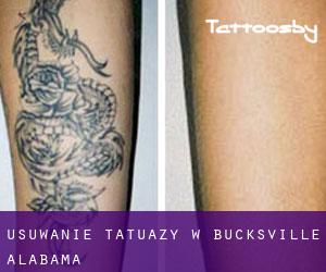 Usuwanie tatuaży w Bucksville (Alabama)