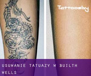 Usuwanie tatuaży w Builth Wells