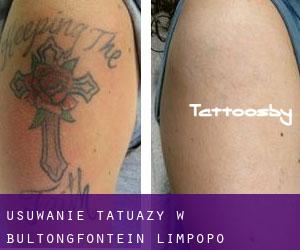 Usuwanie tatuaży w Bultongfontein (Limpopo)