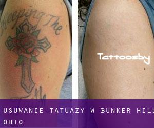 Usuwanie tatuaży w Bunker Hill (Ohio)