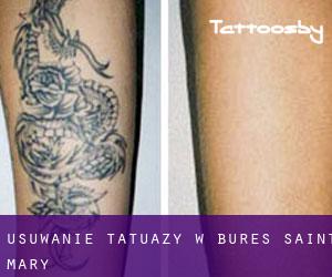 Usuwanie tatuaży w Bures Saint Mary