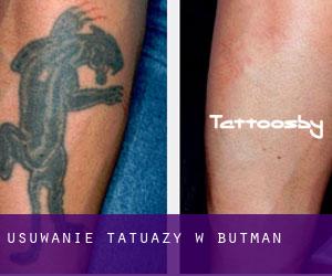 Usuwanie tatuaży w Butman