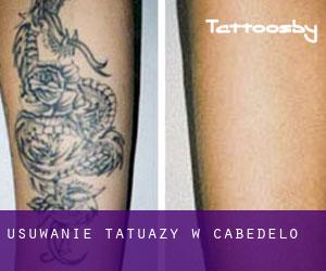 Usuwanie tatuaży w Cabedelo